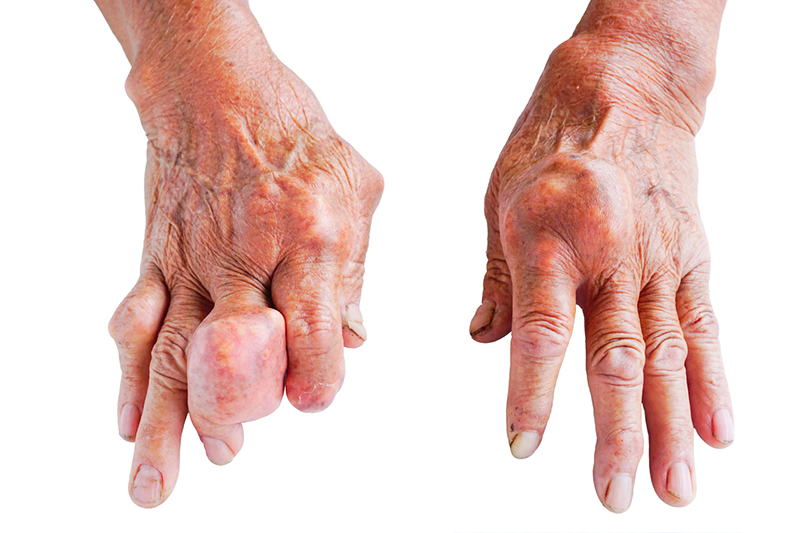 Przewlekła dna moczanowa - często dochodzi do utworzenia tzw. guzków dnawych, zwykle w obrębie stawów rąk i stóp.