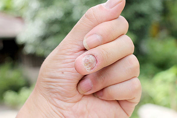 Grzybica paznokci. Leczenie grzybicy paznokci trwa wiele miesięcy