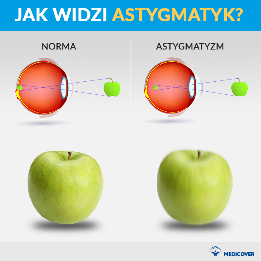 Astygmatyzm Objawy I Leczenie Astygmatyzmu Centrum Medyczne Medicover