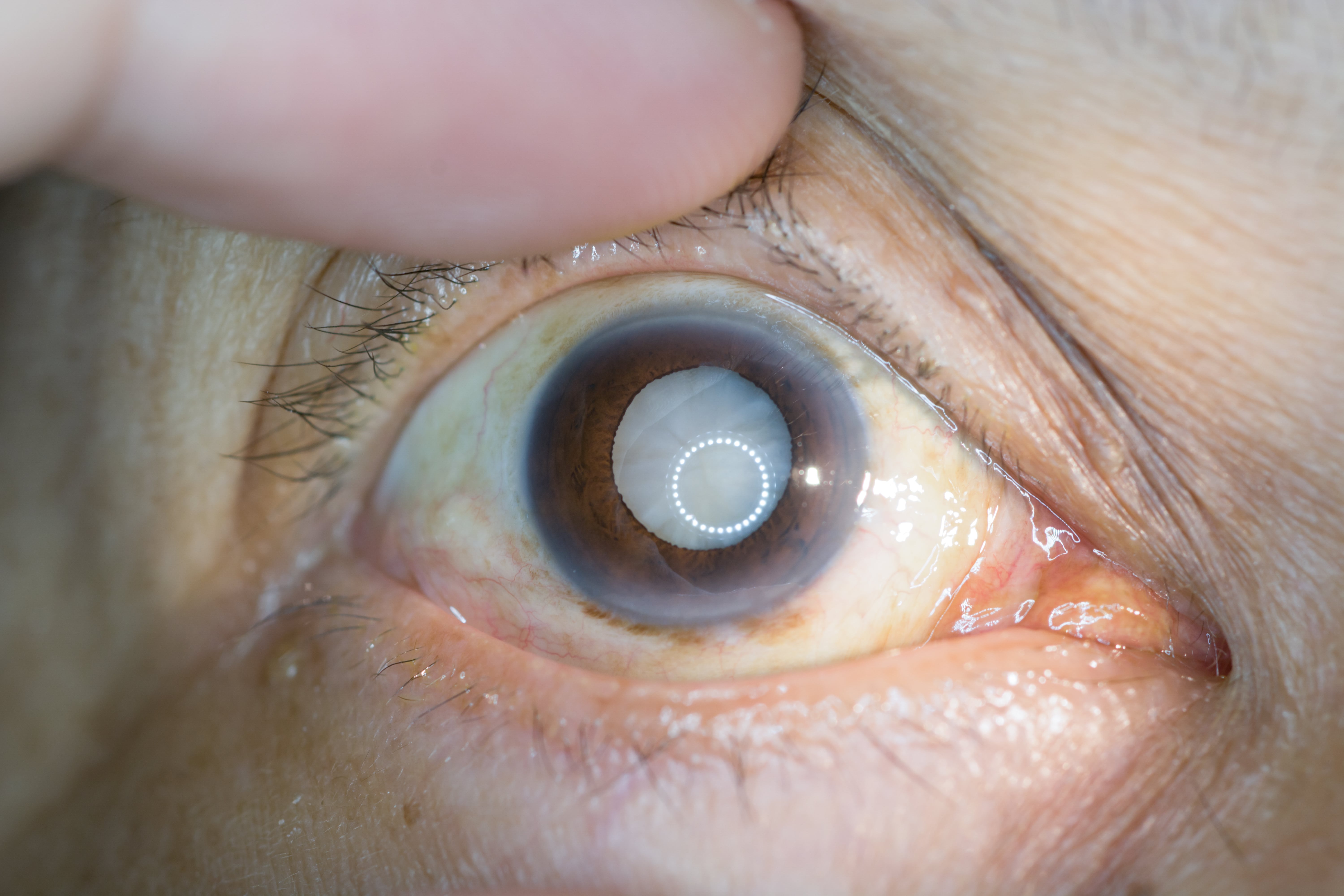 Zaćma jest chorobą oczu, która polega na zmętnieniu soczewki.