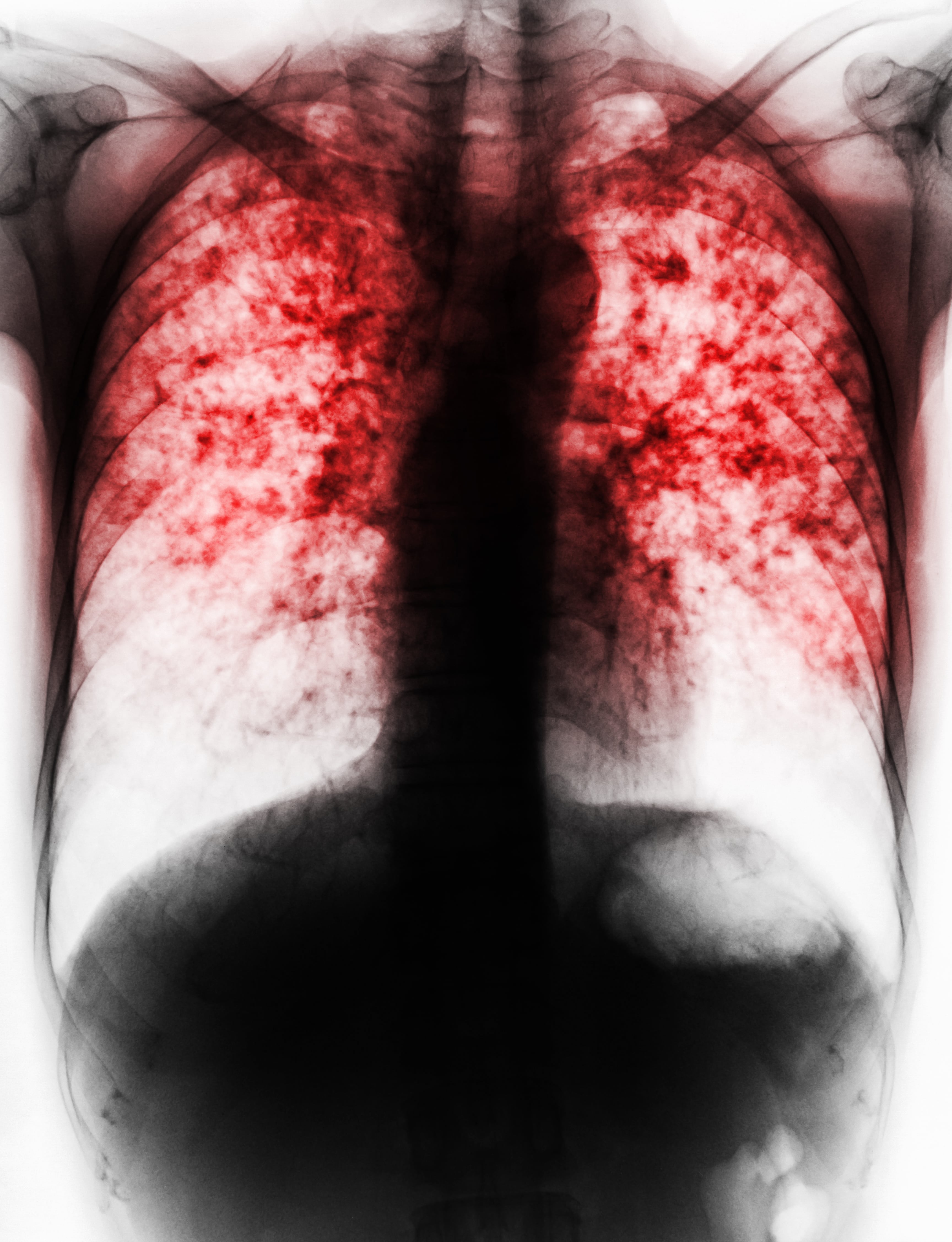 Gruźlica płuc . RTG klatki piersiowej przedstawia zwłóknienie, śródmiąższową infiltrację obu płuc z powodu zakażenia prątkiem gruźlicy.