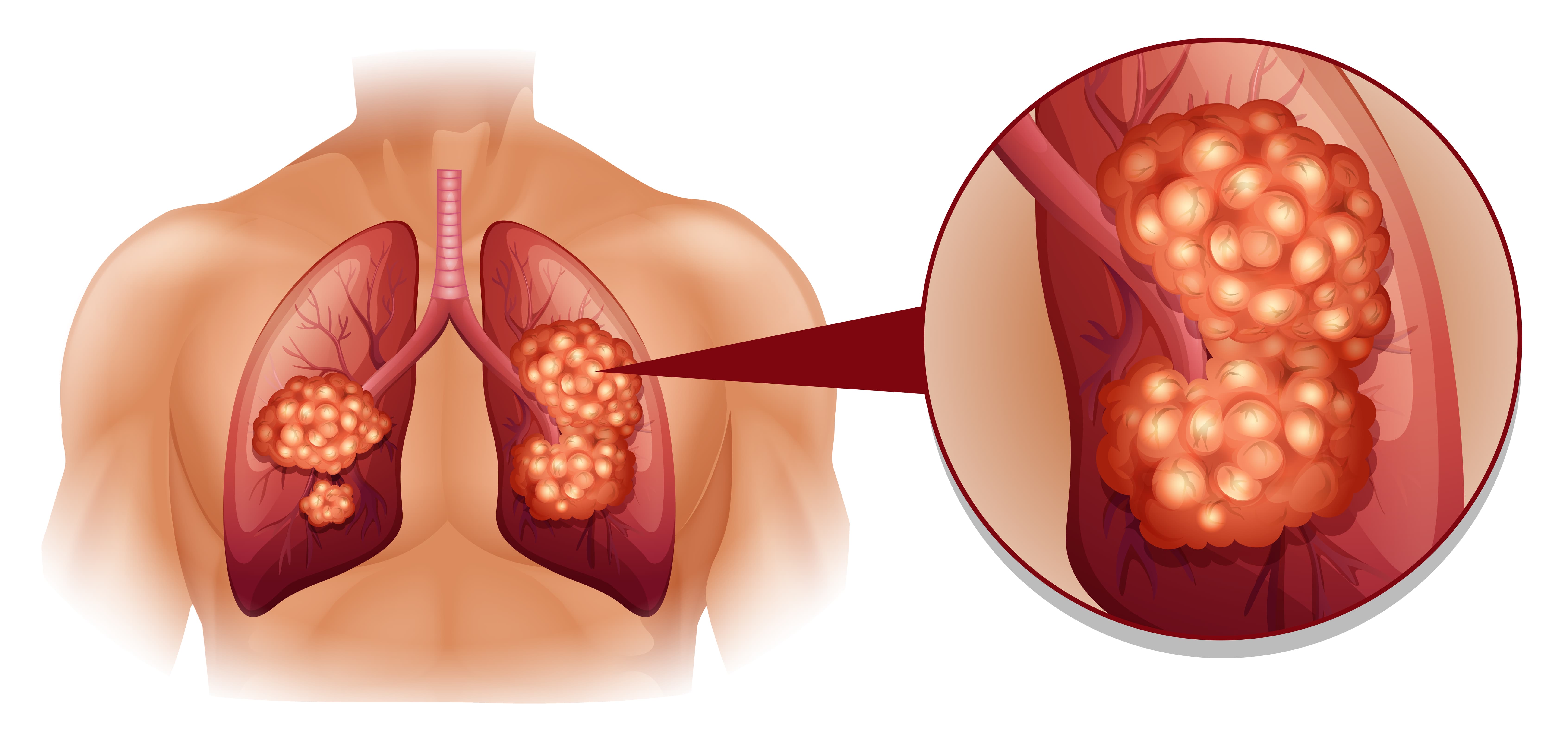 Rak płuc to jeden z najczęstszych i najgorzej rokujących nowotworów złośliwych