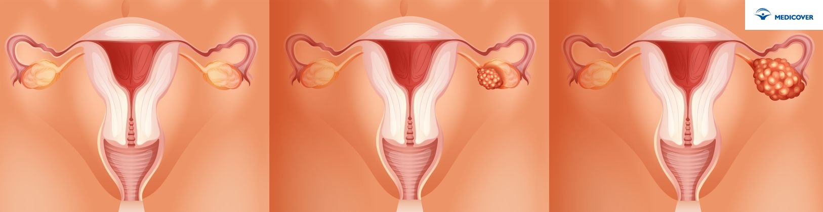 Etapy rozwoju raka jajnika