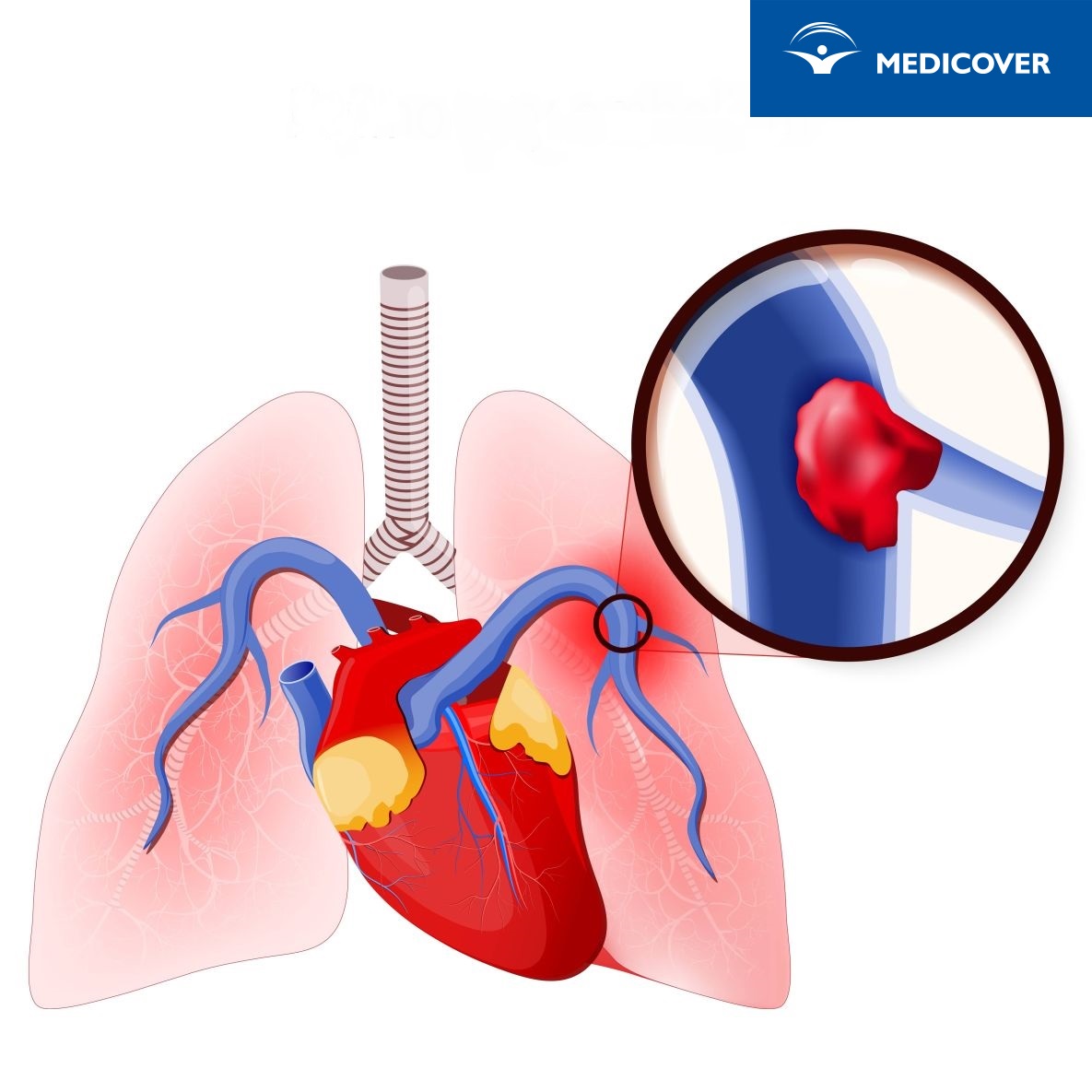 Zakrzepica żył może doprowadzić do zatorowości płucnej