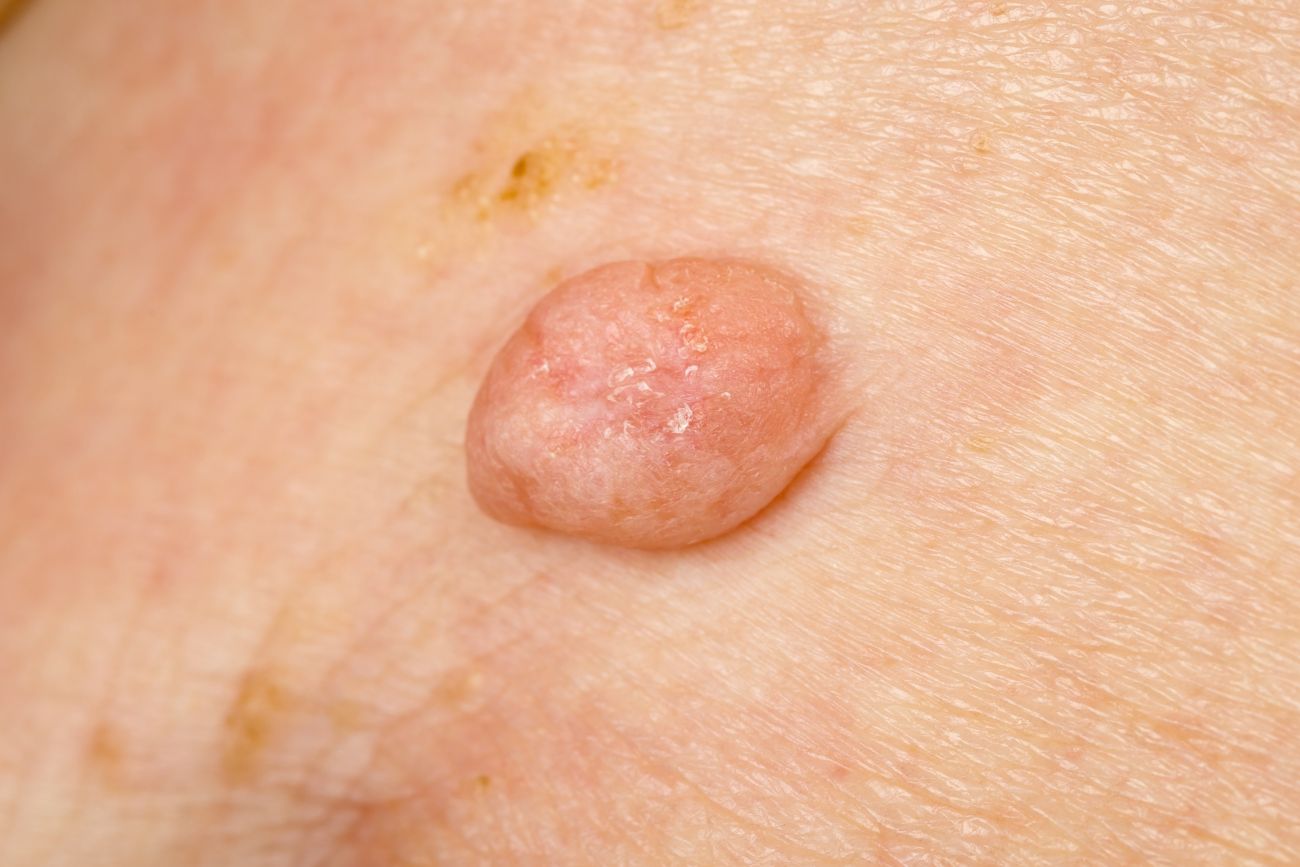 Wirus HPV przyczynia się do rozwoju kurzajek (brodawek wirusowych)