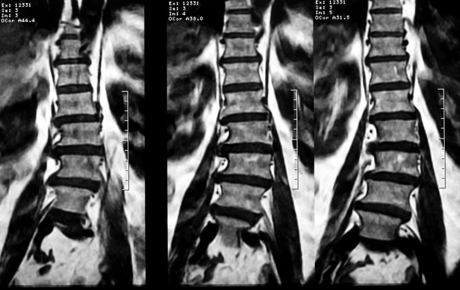 Rezonans magnetyczny kręgosłupa - na zdjęciu widoczna skolioza