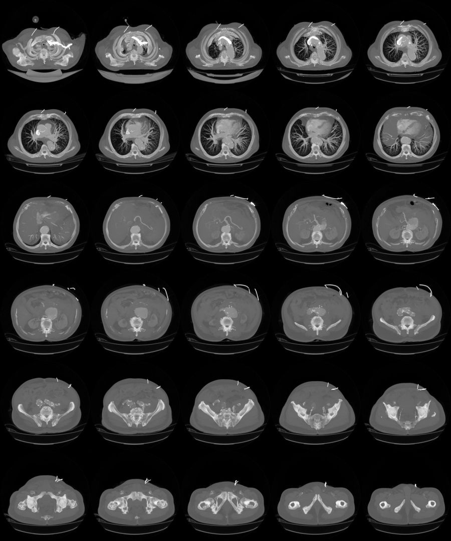 Tomografia komputerowa z klatki piersiowej i brzucha