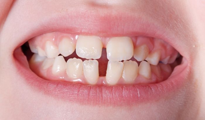 Ortodoncja koryguje wady zgryzu zarówno u dzieci jak i u dorosłych