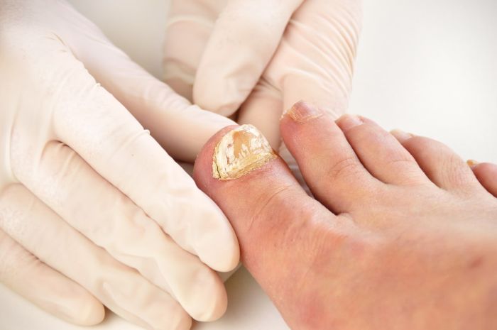 Grzybica paznokci to często efekt nieleczonej grzybicy stóp