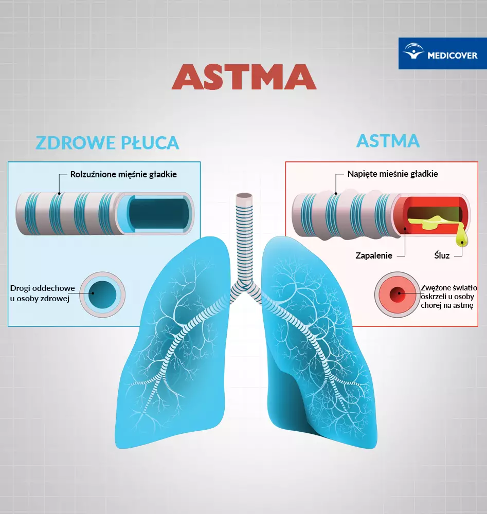Ważne czynniki wpływające na skuteczność leczenia astmy to: właściwy wybór inhalatora i prawidłowa technika inhalowania leku.