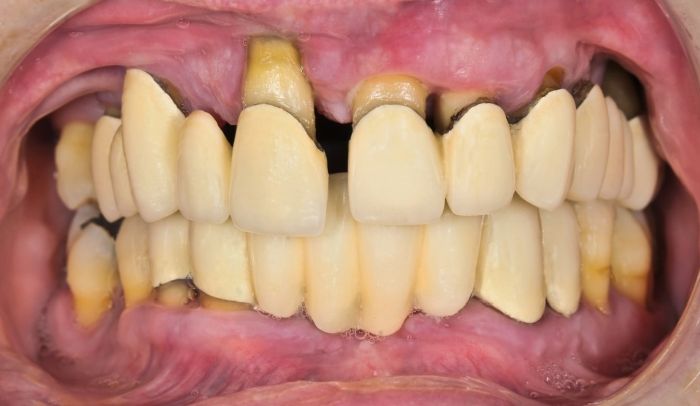 Brak higieny jamy ustnej to główna przyczyna paradontozy