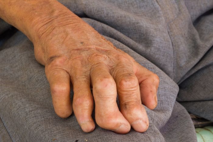 Trąd wywołuje uszkodzenia skóry, nerwów i kończyn