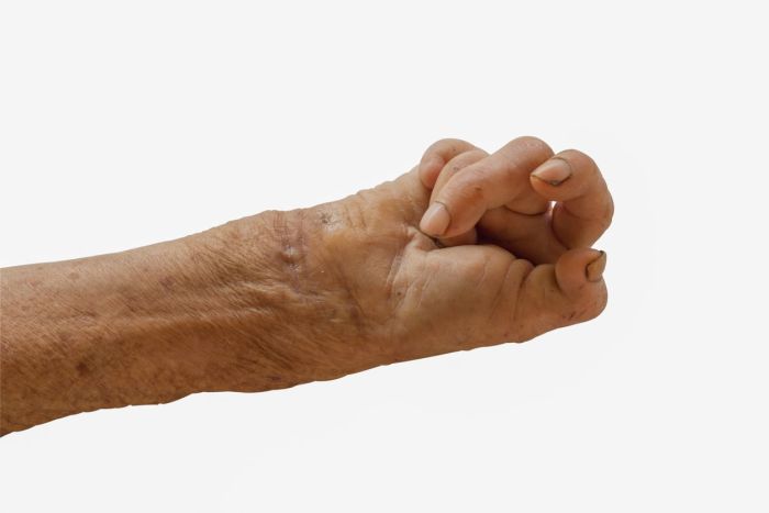 Powikłaniami trądu może być trwałe uszkodzenie nerw&oacute;w w&nbsp;ramionach, nogach i&nbsp;stopach