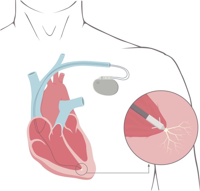 Wszczepialny kardiowerter-defibrylator (ang. implantable cardioverter defibrillator, ICD) to urządzenie umieszczane pod skórą, które śledzi tętno. Cienkie przewody łączą ICD z sercem. Jeśli wykryty zostanie nieprawidłowy rytm serca, urządzenie wywoła impuls elektryczny, aby przywrócić normalne bicie serca