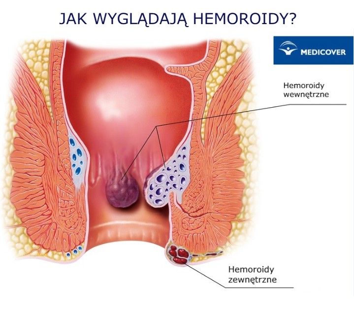 Hemoroidy jak wyglądają?