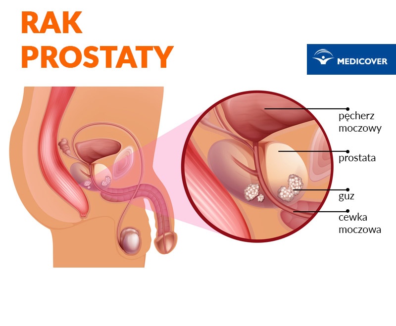 Rak prostaty objawy we wczesnym stadium nie występują.