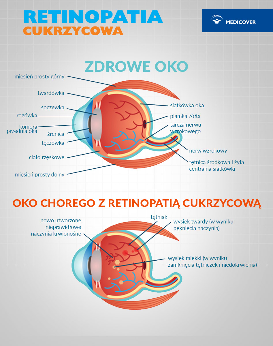 Retinopatia cukrzycowa polega na uszkodzeniu naczyń krwionośnych w siatkówce oka.