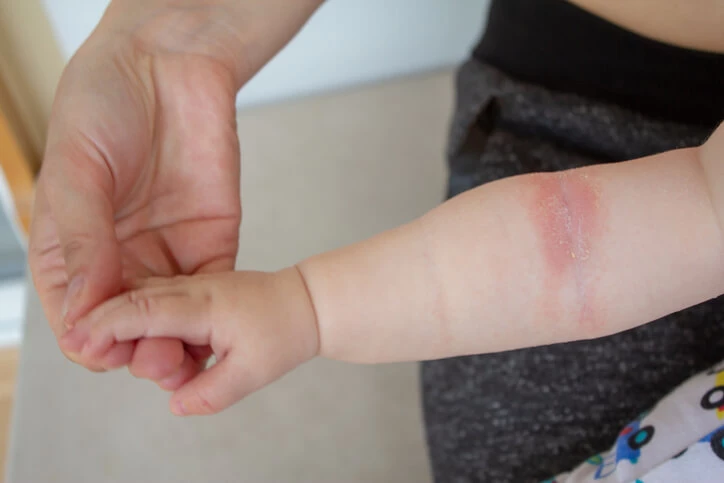 Atopowe zapalenie skóry u niemowląt. Jak wygląda leczenie?