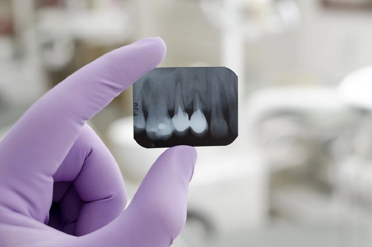 RTG zęba może wykazać zmiany patologiczne.