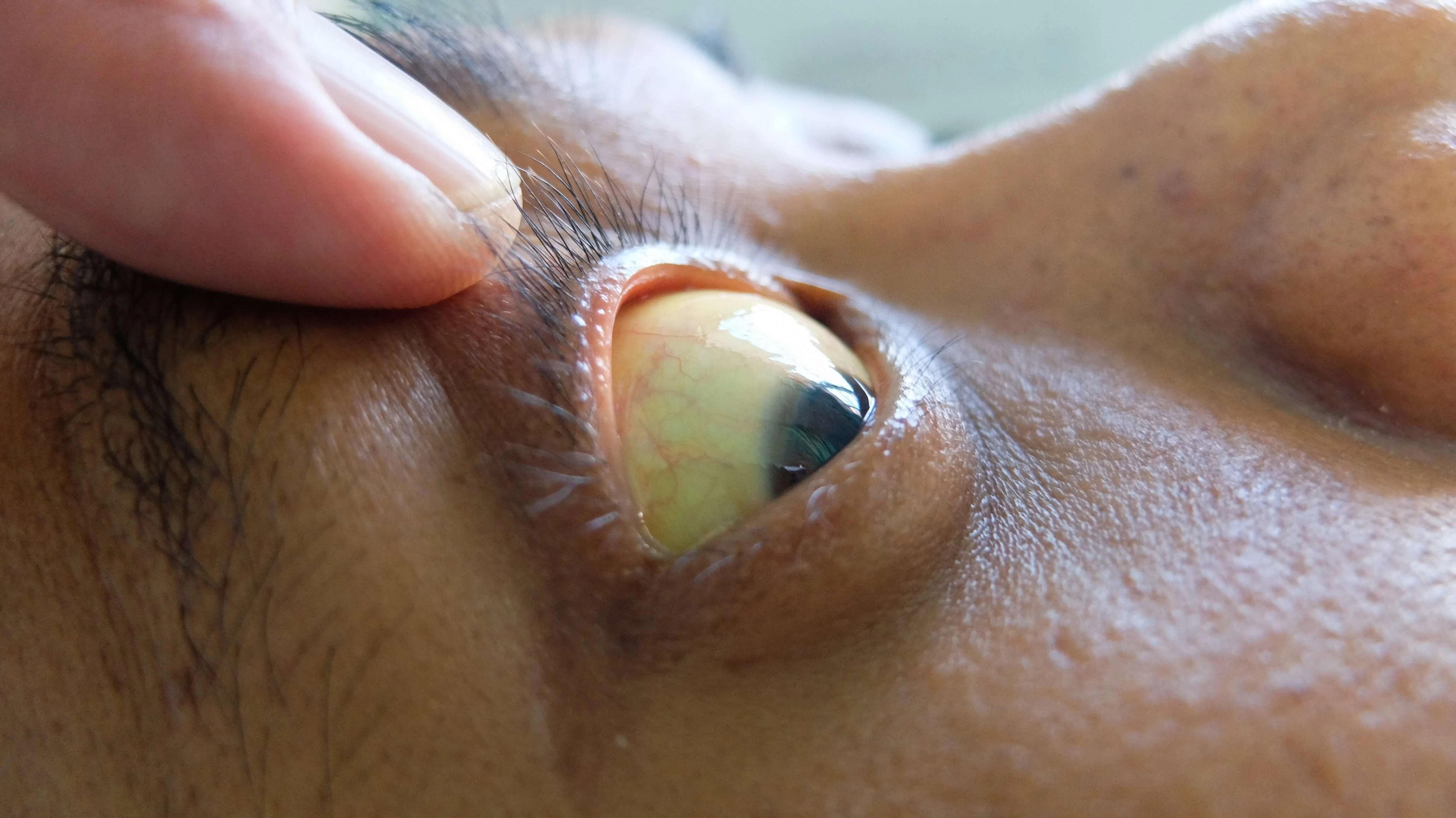 Żółtaczka przy WZW A początkowo zauważalna jest jako zażółcenie białkówek oczu, następnie obejmuje całą skórę.