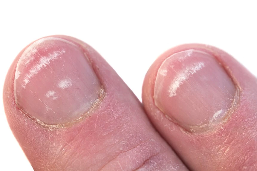 Leukonychia: inne nazwy to bielactwo paznokci, "kwitnące paznokcie".