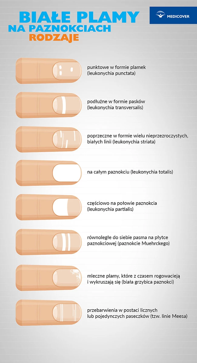Bia e Plamy Na Paznokciach Co Oznaczaj Jakie S Przyczyny