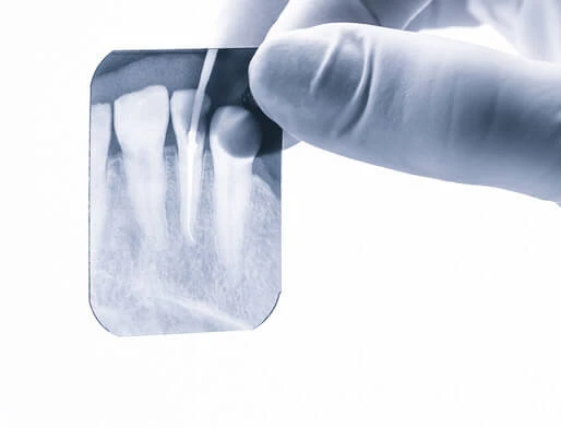 RTG zęba. Dawka promieniowania pomaga uzyskać obraz zębów.