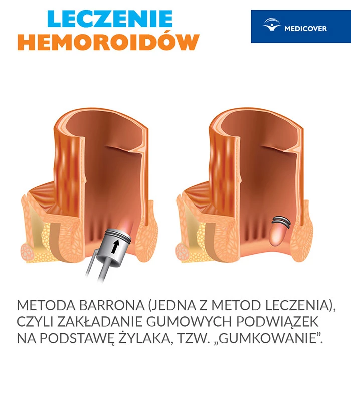 Hemoroidy - metoda Barrona czyli "gumkowanie" hemoroid&oacute;w. Leczenie hemoroid&oacute;w zależy od stopnia zaawansowania choroy. W&nbsp;najgorszym przypadku stosuje się leczenie operacyjne.
