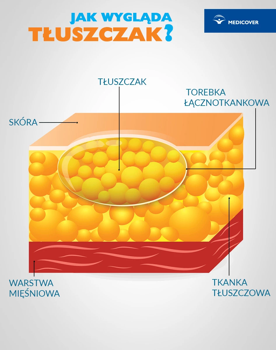 Tłuszczaki zbudowane są z komórek tkanki tłuszczowej, otoczonych torebką łącznotkankową.