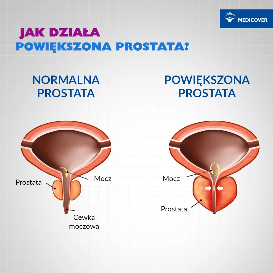 Nie każdy rozrost prostaty to rak. Powiększony gruczoł naciska na pęcherz moczowy.