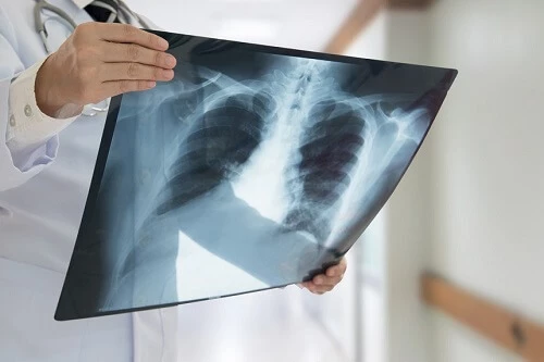 Prześwietlenie płuc jest pomocne m.in. w diagnozie zmian śródmiąższowych.