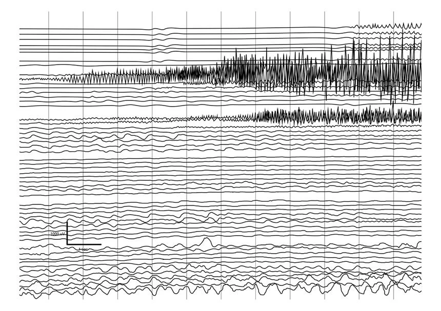 Jak wygląda zapis EEG? Na zdjęciu fale podczas napadu padaczki.