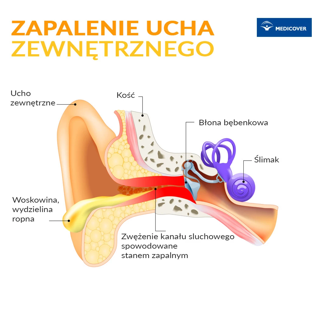 Wyciek z przewodu słuchowego jest najczęściej objawem chorób o charakterze zapalnym ucha zewnętrznego lub środkowego.