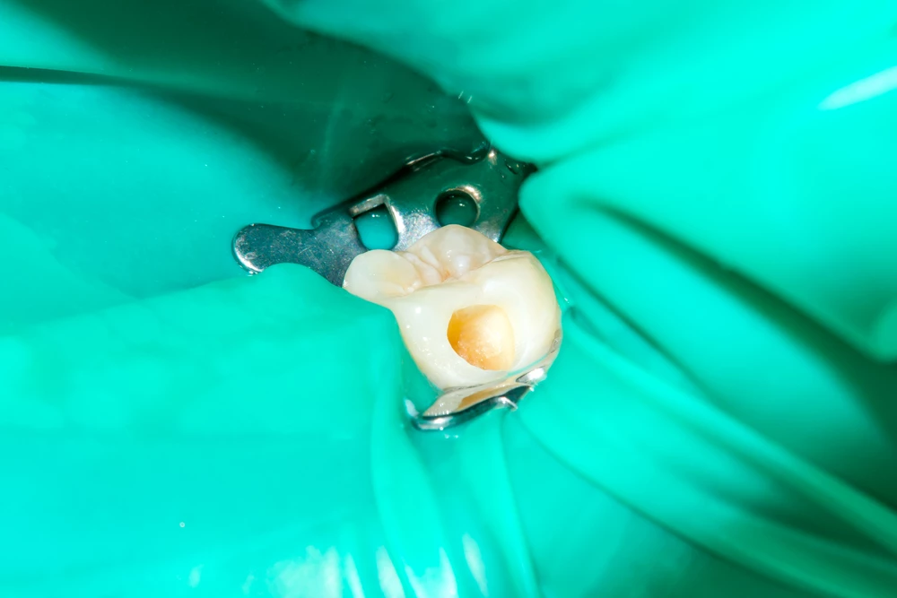 Koferdam - wielkość otworów jest regulowana w zależności od wielkości zęba.