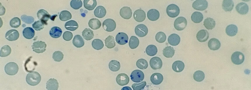Oznaczenie liczby retikulocytów (na zdjęciu obraz mikroskopowy) wykonuje się na podstawie próbki krwi.