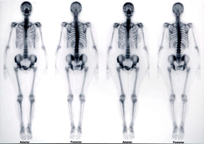 Scyntografia kości wykazuje zmiany w układzie kostnym.