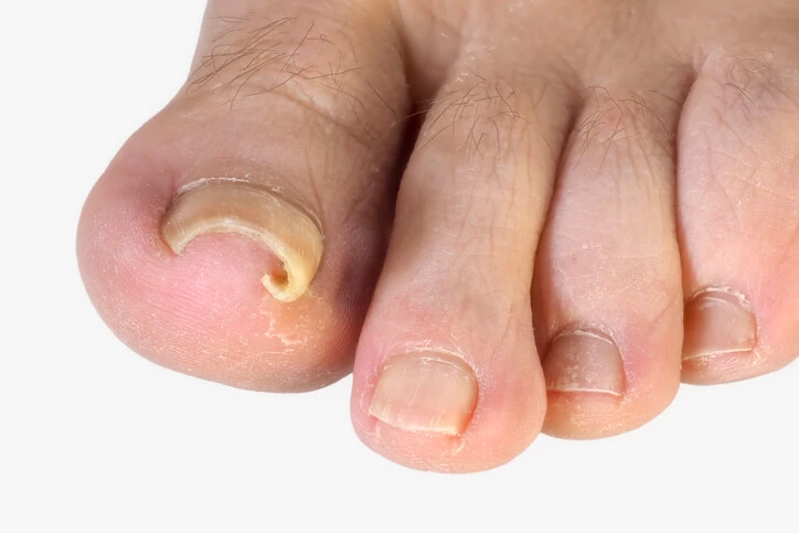 Duży palec stopy objęty schorzeniem. Jakie są zabiegi na wrastające paznokcie?