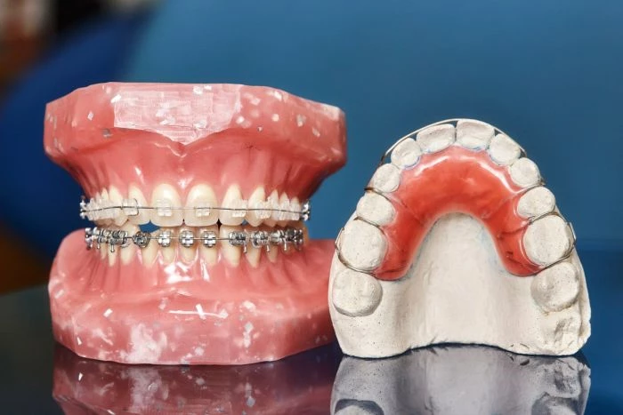 Skutkiem noszenia aparatu ortodontycznego jest unormowanie zgryzu