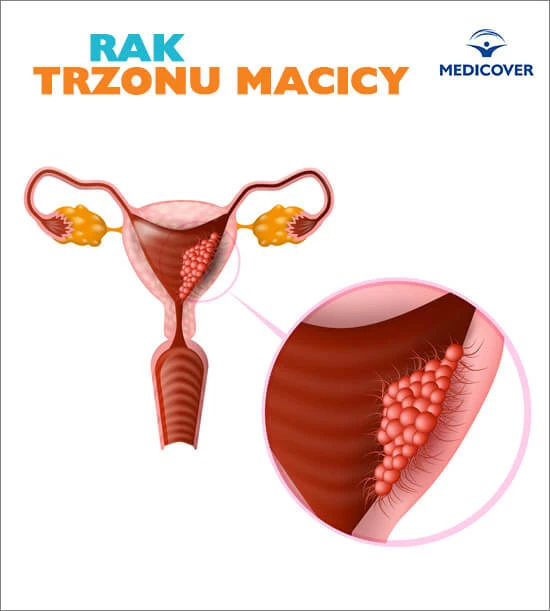 Rak endometrium - objawy choroby są skutkiem powstania komórek nowotworowych w obszarze błony śluzowej trzonu macicy.