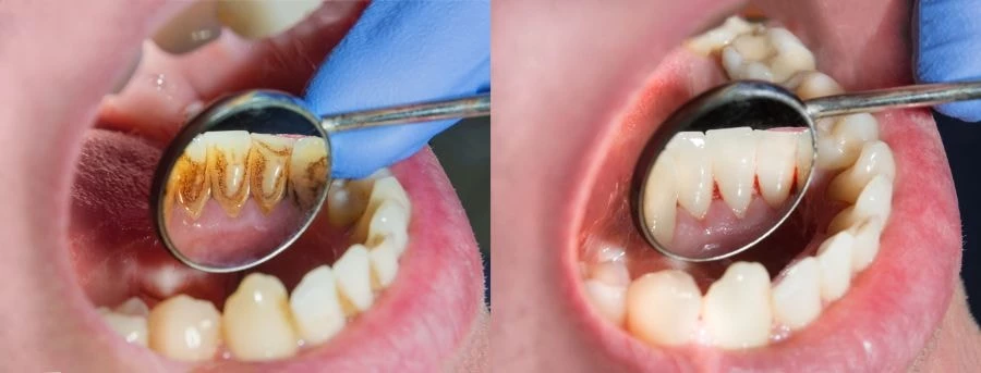 Czyszczenie zębów palacza - efekt przed i po zabiegu