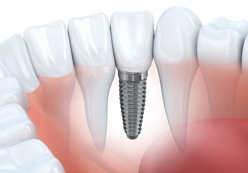 Implant zębowy z powodzeniem zastępuje brakujący ząb.