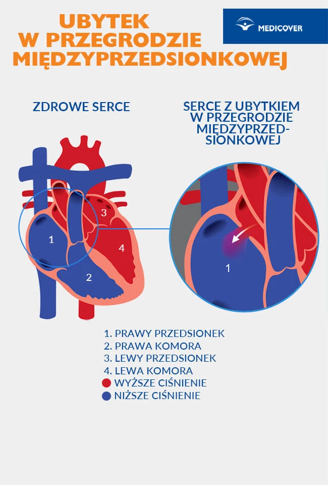 Ubytek przegrody międzyprzedsionkowej