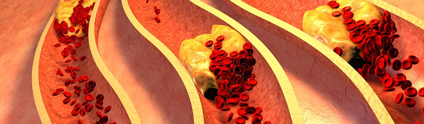 Wskazaniem do oznaczenia cholesterolu całkowietego jest np. miażdżyca, choroba wieńcowa, hipercholesterolemia rodzinna.