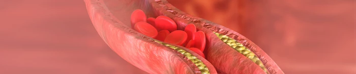 O czym świadczy nadmiar cholesterolu?