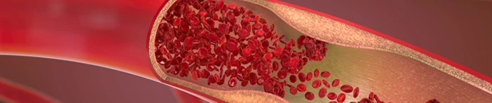 Poziom cholesterolu LDL we krwi badanie.