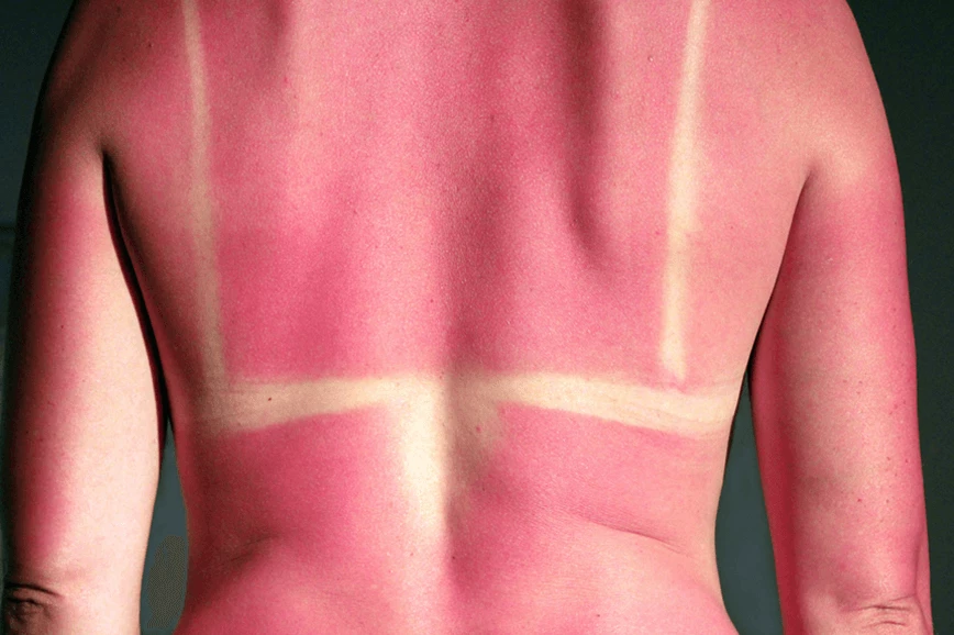 Oparzenia słoneczne są jednym z najważniejszych znanych czynników ryzyka rozwoju nowotworów skóry