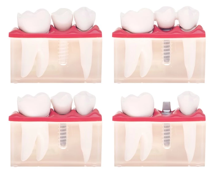 Każdy implant zęba przybiera postać śruby wkręcanej w kości szczęki lub żuchwy
