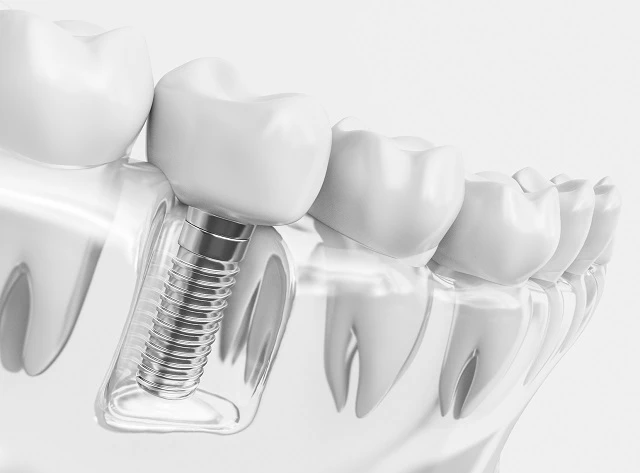 Wszczepianie implantu zęba polega na umieszczeniu w kości specjalnej śruby