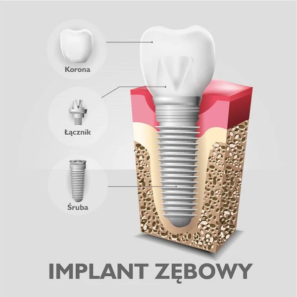 Implant zęba to rozwiązanie na braki zębowe