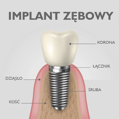Implant zęba to śruba, którą wkręca się w kość